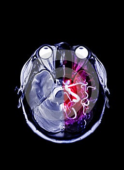 Fusion image MRI and MRA Brain .