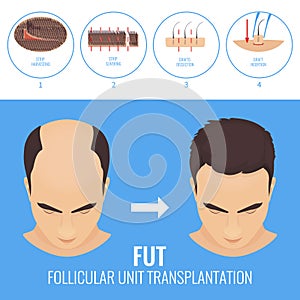 FUT hair loss treatment