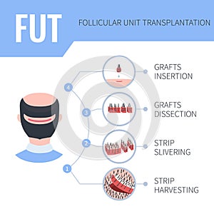 FUT hair transplantation medical infographics for men