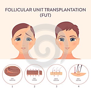 FUT hair transplantation procedure medical infographic poster
