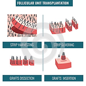 FUT hair transplantation procedure stages medical infographics