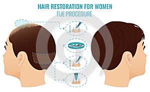 FUT treatment for women