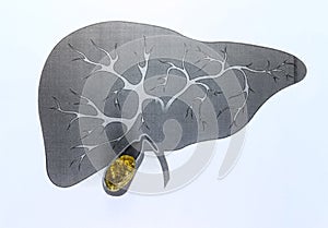 Gall bladder stone, schematic depiction, large sized Gallstone, Result of gallstone disease photo