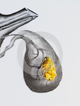 Gall bladder stone, schematic depiction, large sized Gallstone, Result of gallstone disease