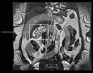 Gall-stones, cholecystitis. MRI investigation. photo