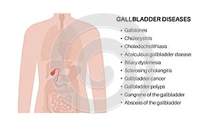 gallbladder anatomy poster photo