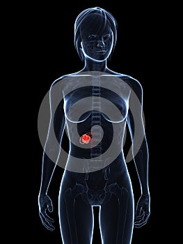 Gallbladder cancer