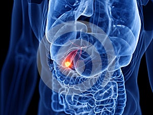 The gallbladder cancer