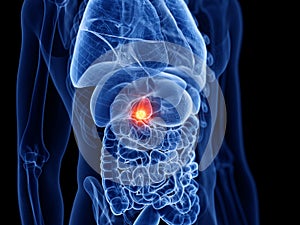The gallbladder cancer