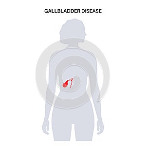 gallbladder disease poster photo