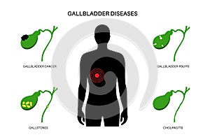 Gallbladder diseases poster photo