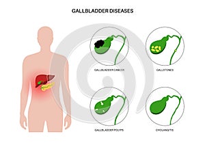 Gallbladder diseases poster photo