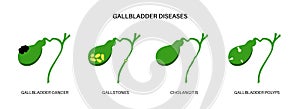 Gallbladder diseases poster photo