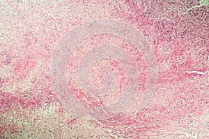 Gallbladder necrosis tissue