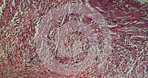Gallbladder necrosis tissue