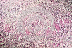 Gallbladder necrosis tissue under the microscope
