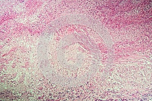 Gallbladder necrosis tissue under the microscope