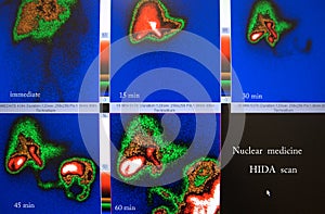 Gallbladder ejection fraction nuclear scan
