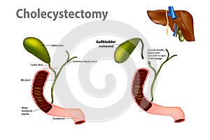 Vesícula biliar eliminación cirugía 