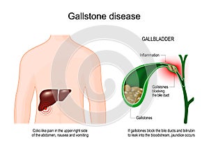 Gallstone disease. Cross section of Gallbladder with Gallstones photo