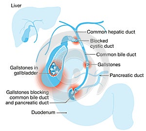 Gallstone disease. gallstones blocking bile duct and pancreatic duct. Labeled Illustration