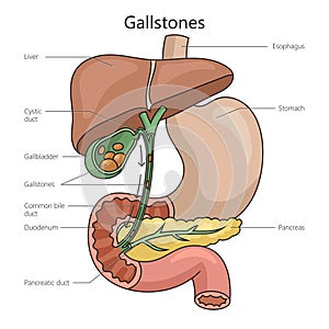 Gallstone structure diagram medical science photo