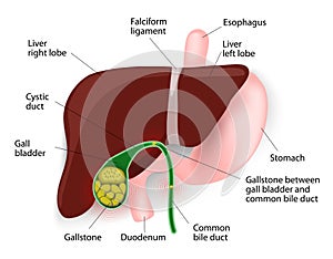 Gallstones