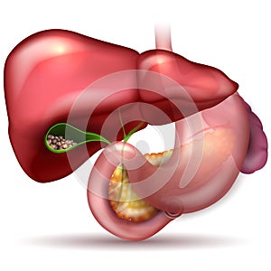 Gallstones