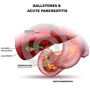 Gallstones and acute pancreatitis photo