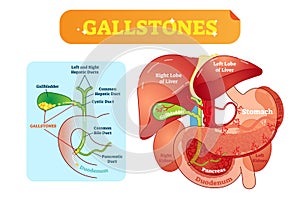 Gallstones anatomical cross section vector illustration diagram with abdominal cavity and gallbladder, bile ducts and duodenum. photo