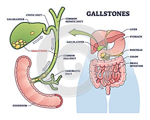 Gallstones as stones of cholesterol in gallbladder organ outline diagram