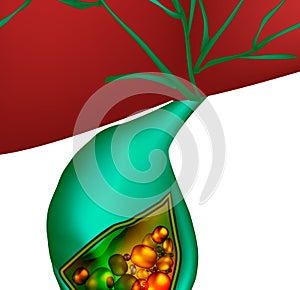 Gallstones. Cholelithiasis. Cholecystitis. Inflammation of the gallbladder. Infographics. Vector illustration on