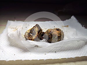 Gallstones close up. Calculi in the hands of the surgeon after laparoscopy, surgery to remove the gallbladder. Complications of
