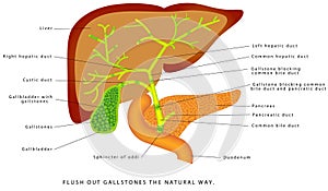 Gallstones in the gallbladder.