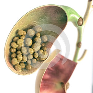 Gallstones in gallbladder and bile duct - high details - 3D rendering