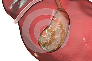 Gallstones, illustration showing bottom view of liver and gallbladder with stones