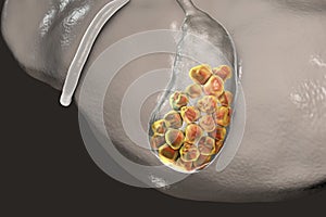 Gallstones, illustration showing bottom view of liver and gallbladder with stones