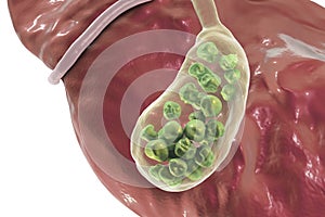 Gallstones, illustration showing bottom view of liver and gallbladder with stones