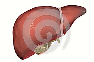 Gallstones, illustration showing front view of liver and gallbladder with stones