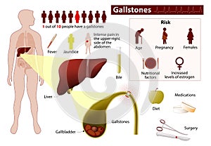 Gallstones. Medical infographic