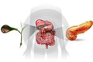 Gallstones, pancreatitis photo