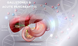 Gallstones and Pancreatitis photo