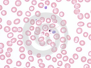 Gametocyte of Plasmodium falciparum in peripheral blood.