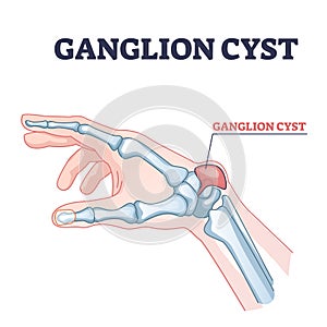 Ganglion cyst as tendon fluid filled swelling near arm joint outline diagram photo
