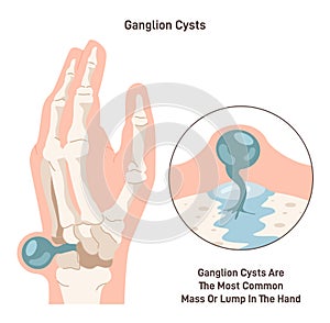 Ganglion cyst. Fluid-filled lump under the skin of a wrist or hand. Synovial