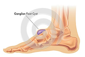 Ganglion cyst on foot