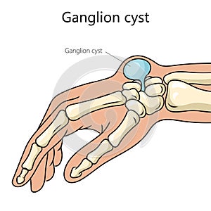 Ganglion cyst structure diagram medical science