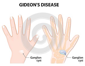 Ganglion cyst or synovial cyst photo