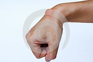 Ganglion cyst on woman hand on white background photo