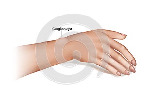 Ganglion Cyst of the Wrist and Hand. Synovial cyst or a Gideon`s Disease, or a Bible Cyst, or a Bible Bump